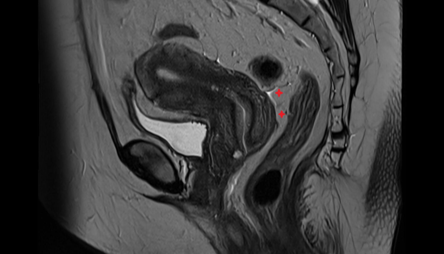rectouterine pouch  MRI sagittal  anatomy  image-img-00000-00000_00001