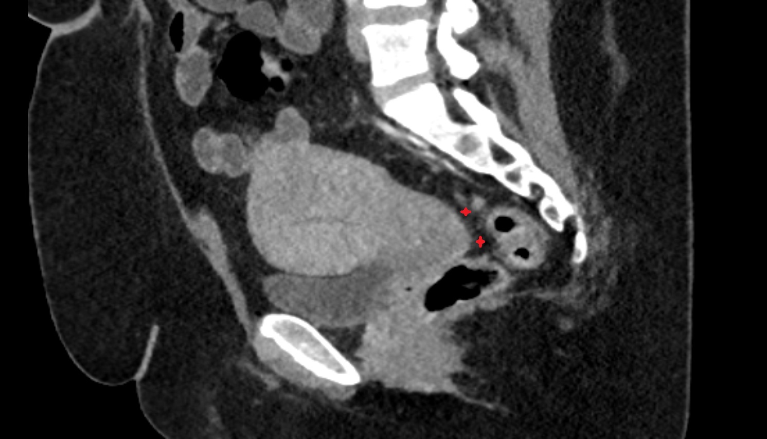 rectouterine pouch  ct  sagittal  anatomy  image-img-00000-00000