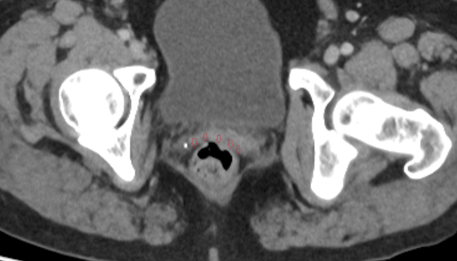 rectovaginal septum CT axial  image  anatomy  image