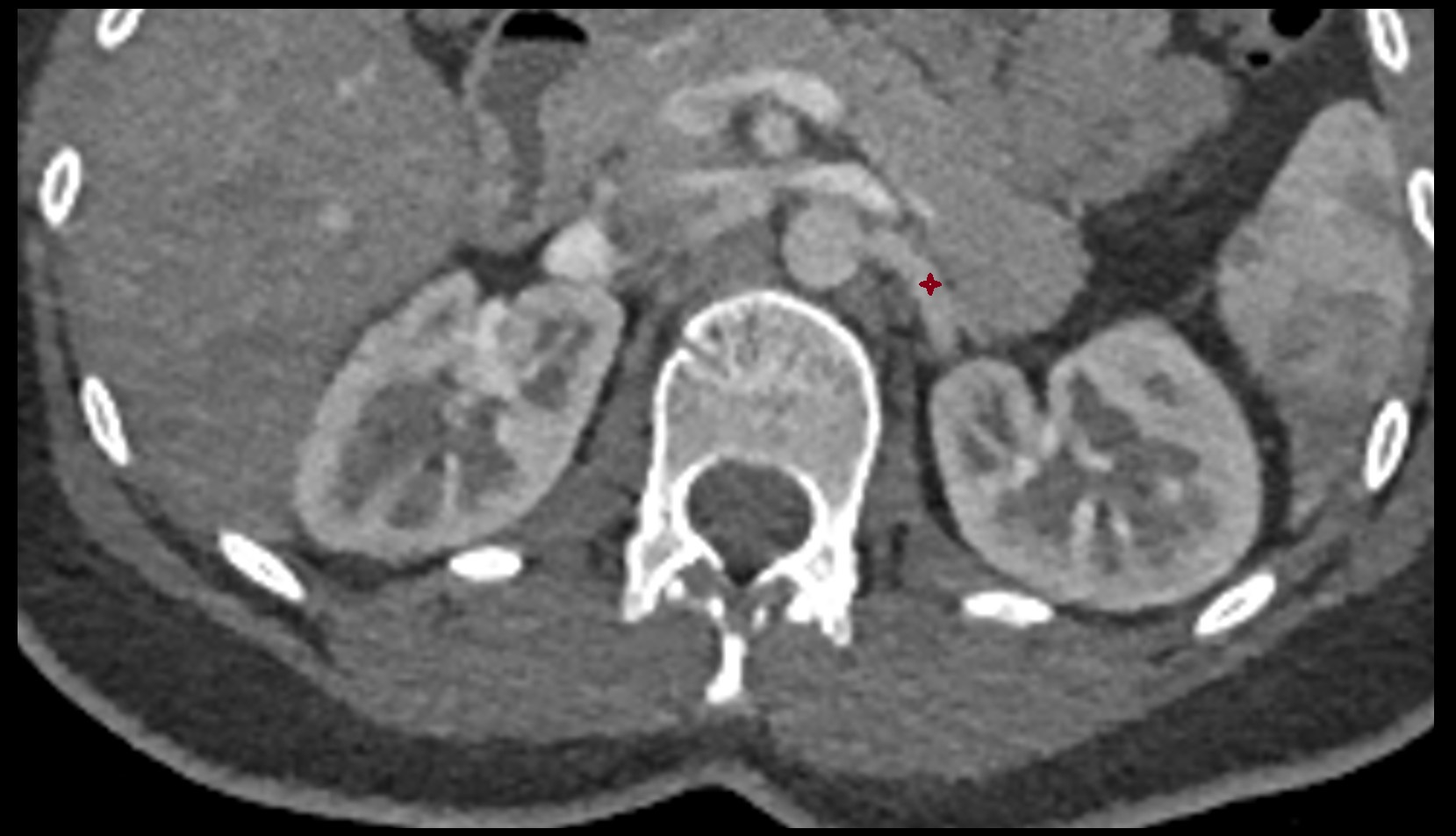 renal artery  CT axial  image anatomy