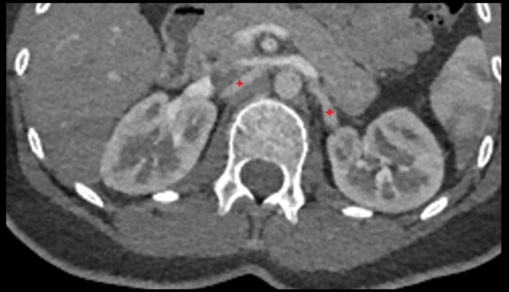 renal artery  CT axial  image anatomy 1