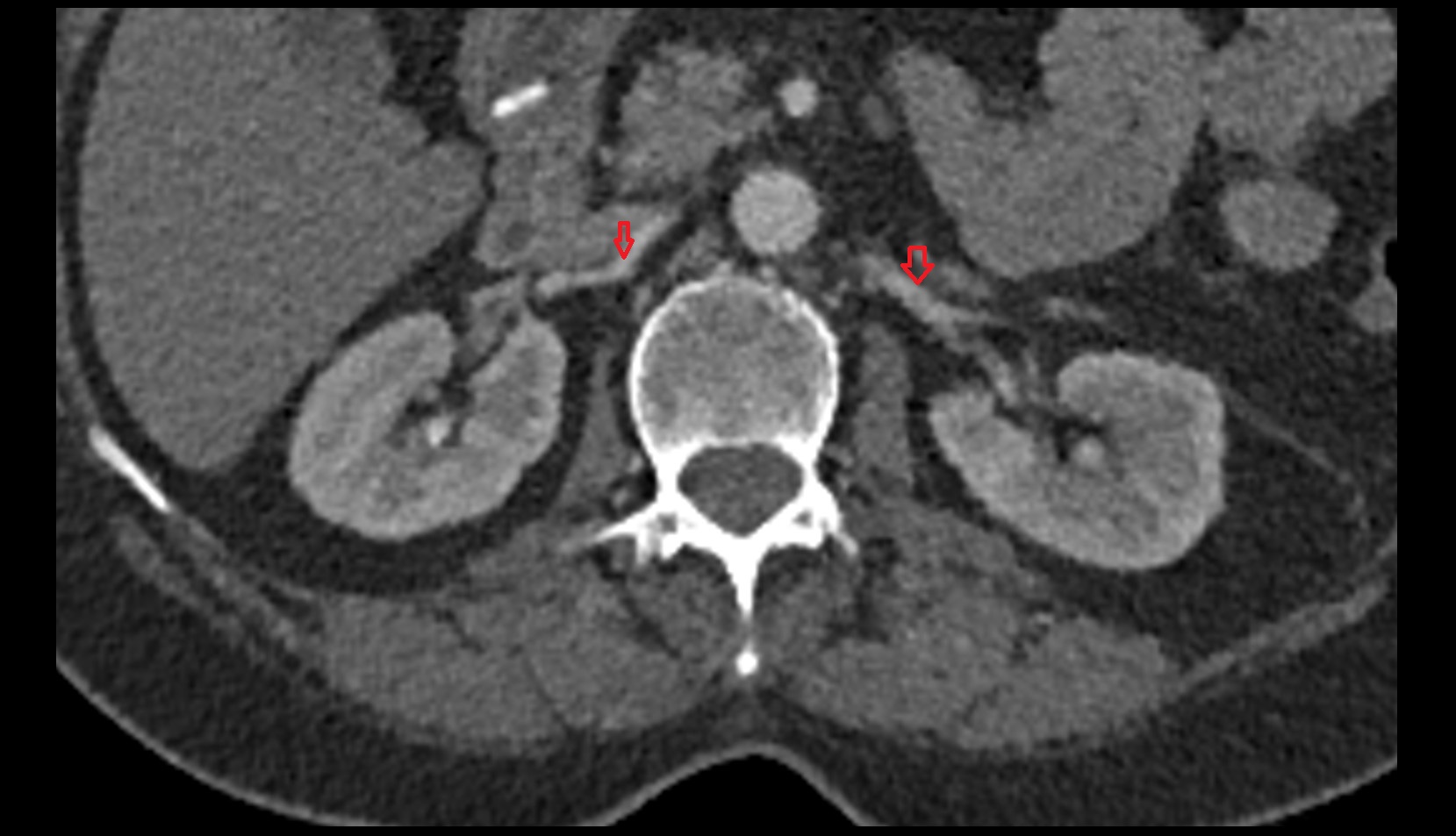 renal artery  CT axial  image anatomy 2