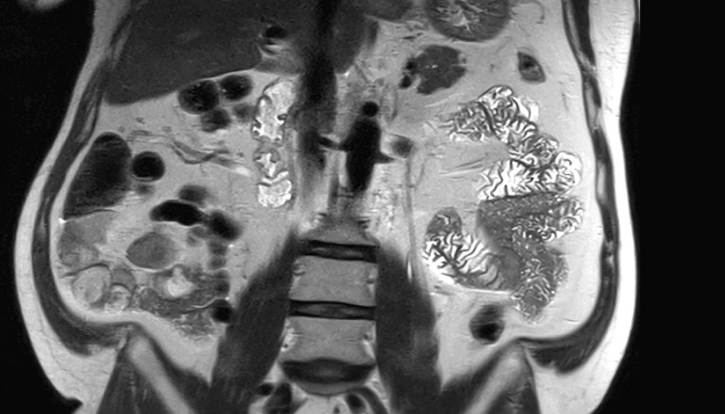 renal artery  MRI coronal image anatomy  image -img-00000-00000