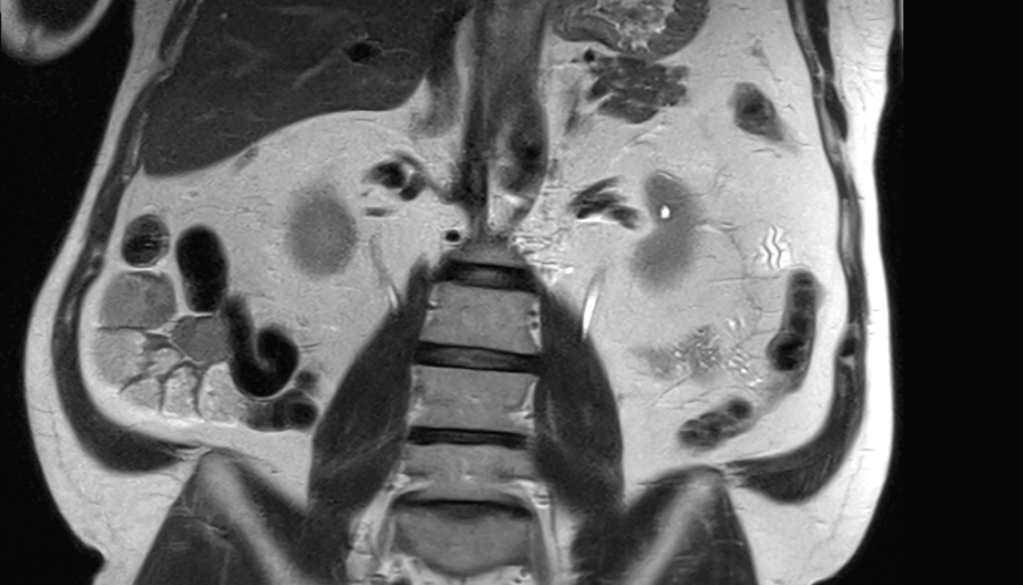 renal artery  MRI coronal image anatomy  image -img-00000-00000_00001