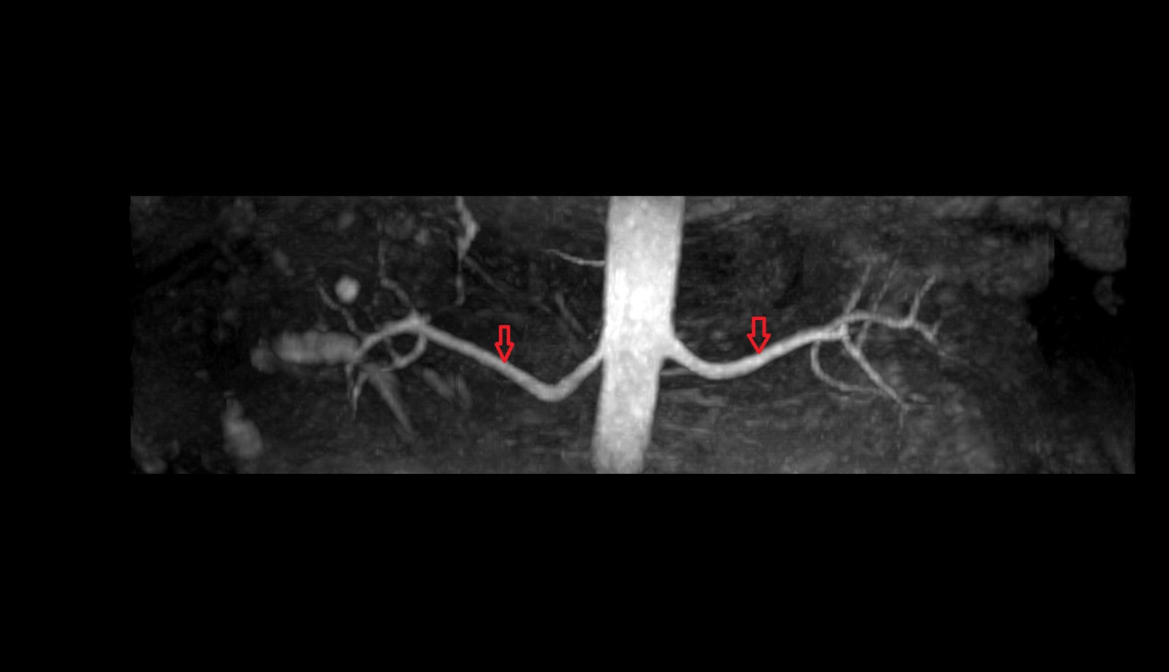 renal artery mri coronal imip image