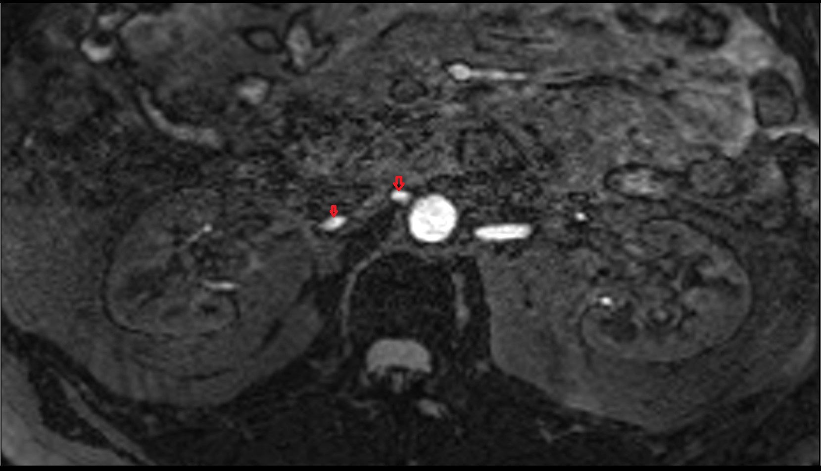 right Renal Artery axial