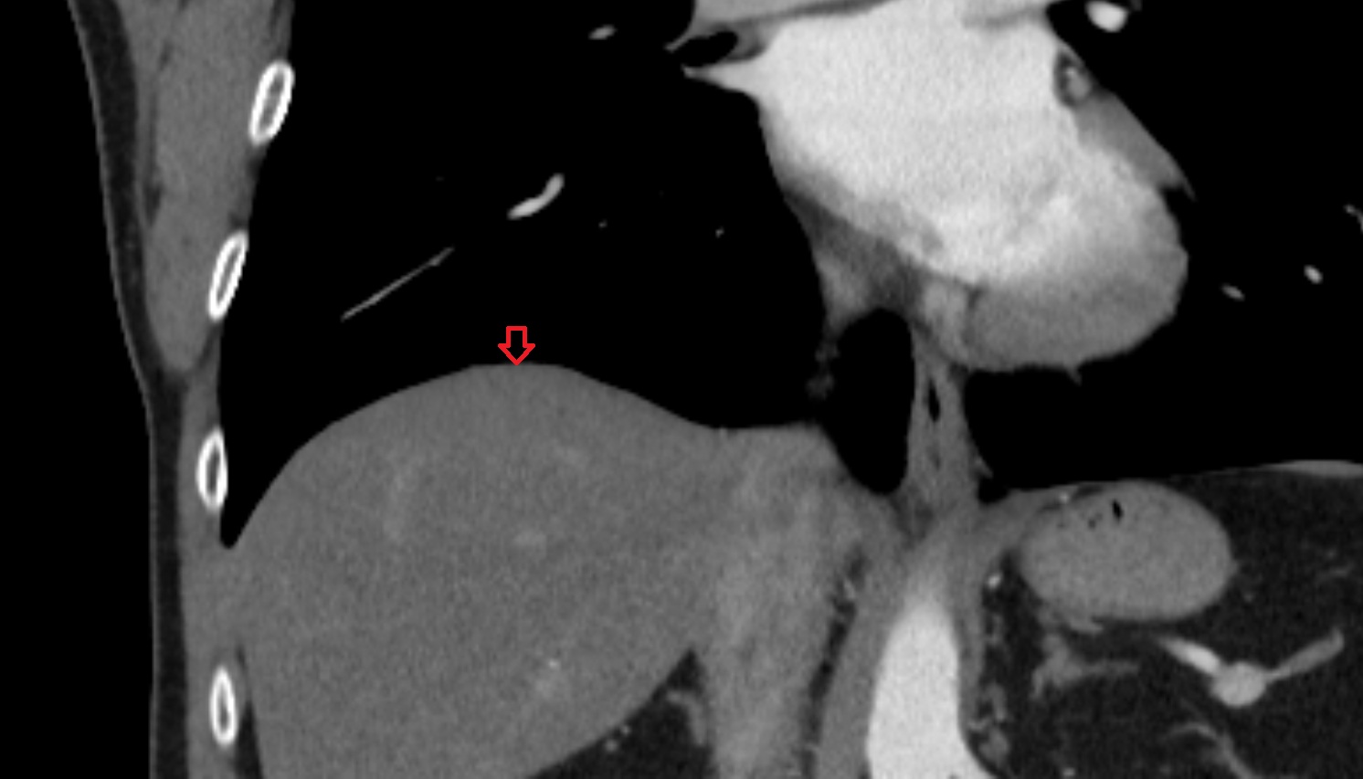 right hemidiaphragm CT coronal  image -img-00000-00000
