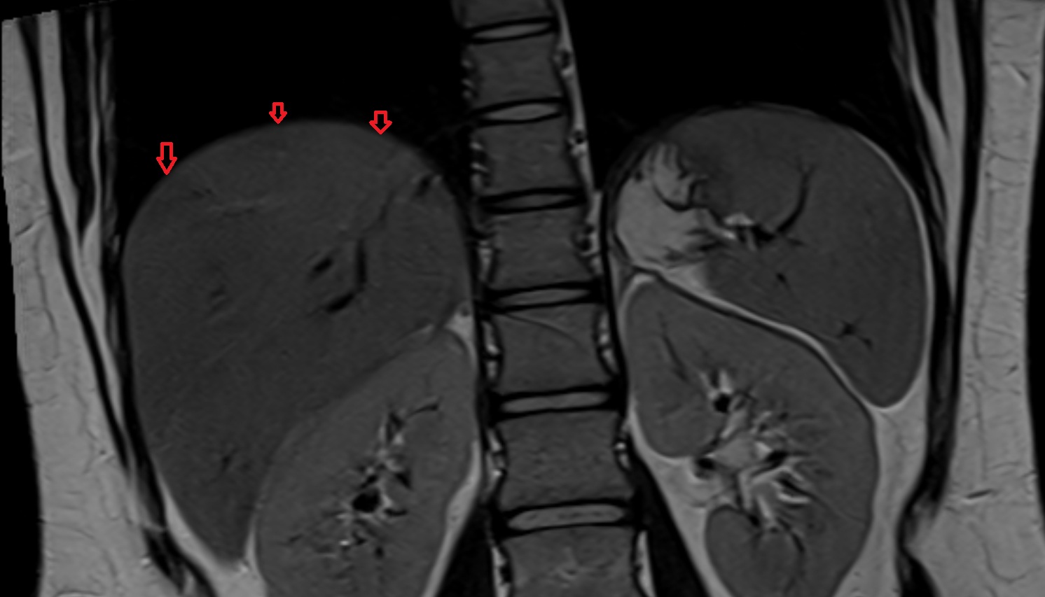 right hemidiaphragm MRI coronal  image -img-00000-00000