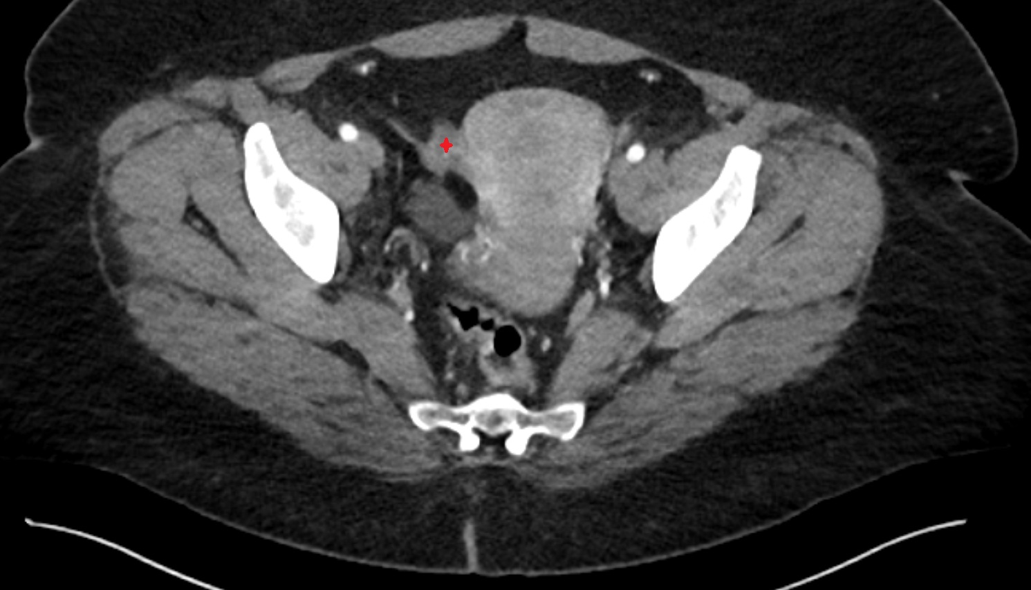 right ovary ct  axial  image anatomy  image-img-00000-00000