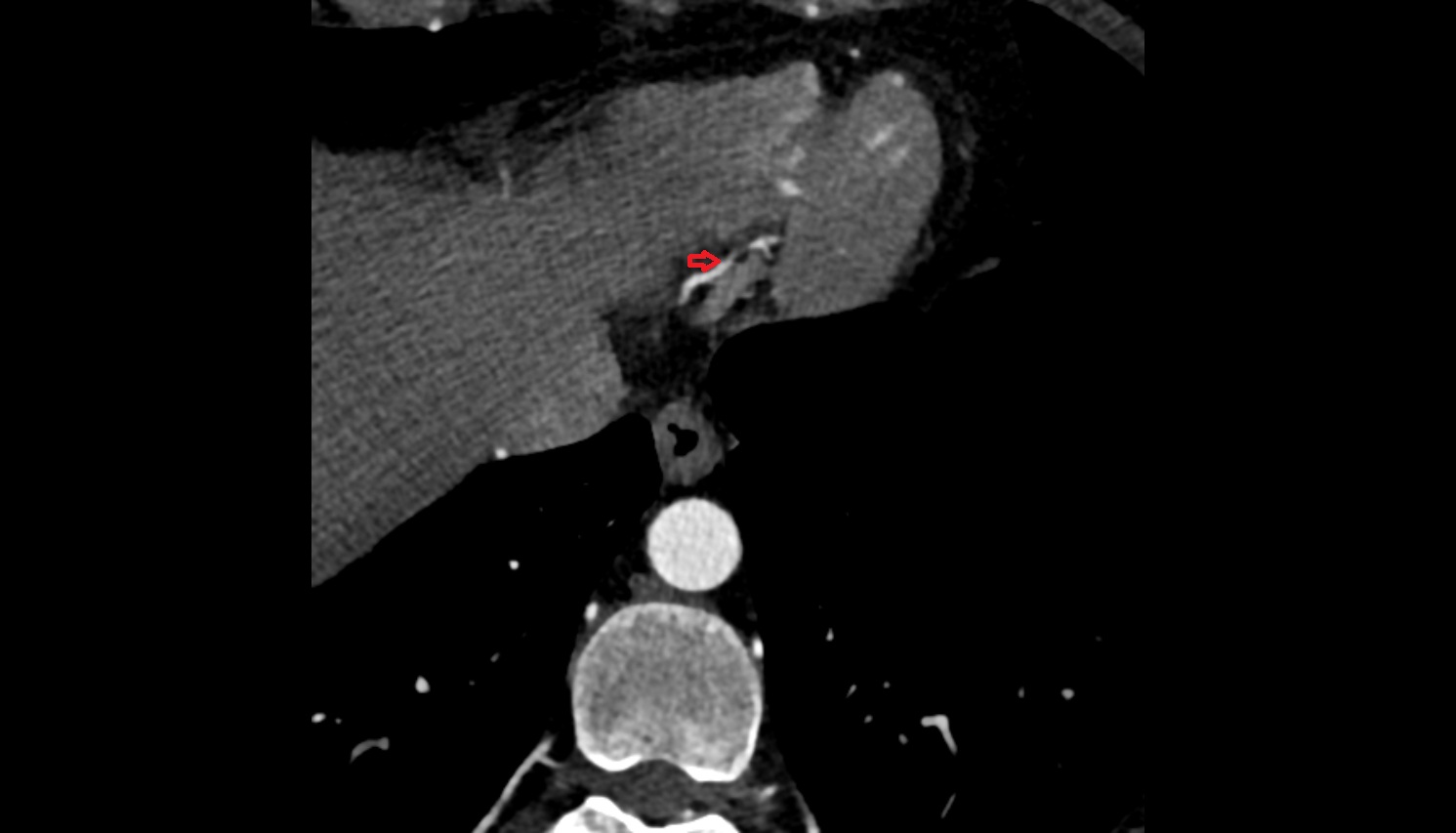 right posterior descending coronary artery ct axial  anatomy  image -img-00000-00000