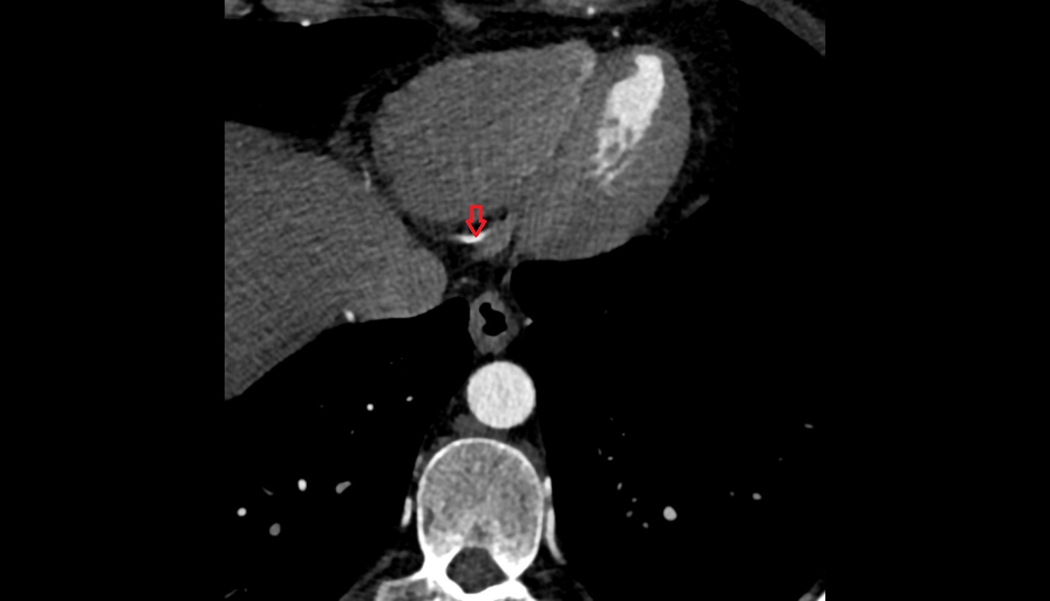 right posterior descending coronary artery ct axial  anatomy  image -img-00000-00000_00001