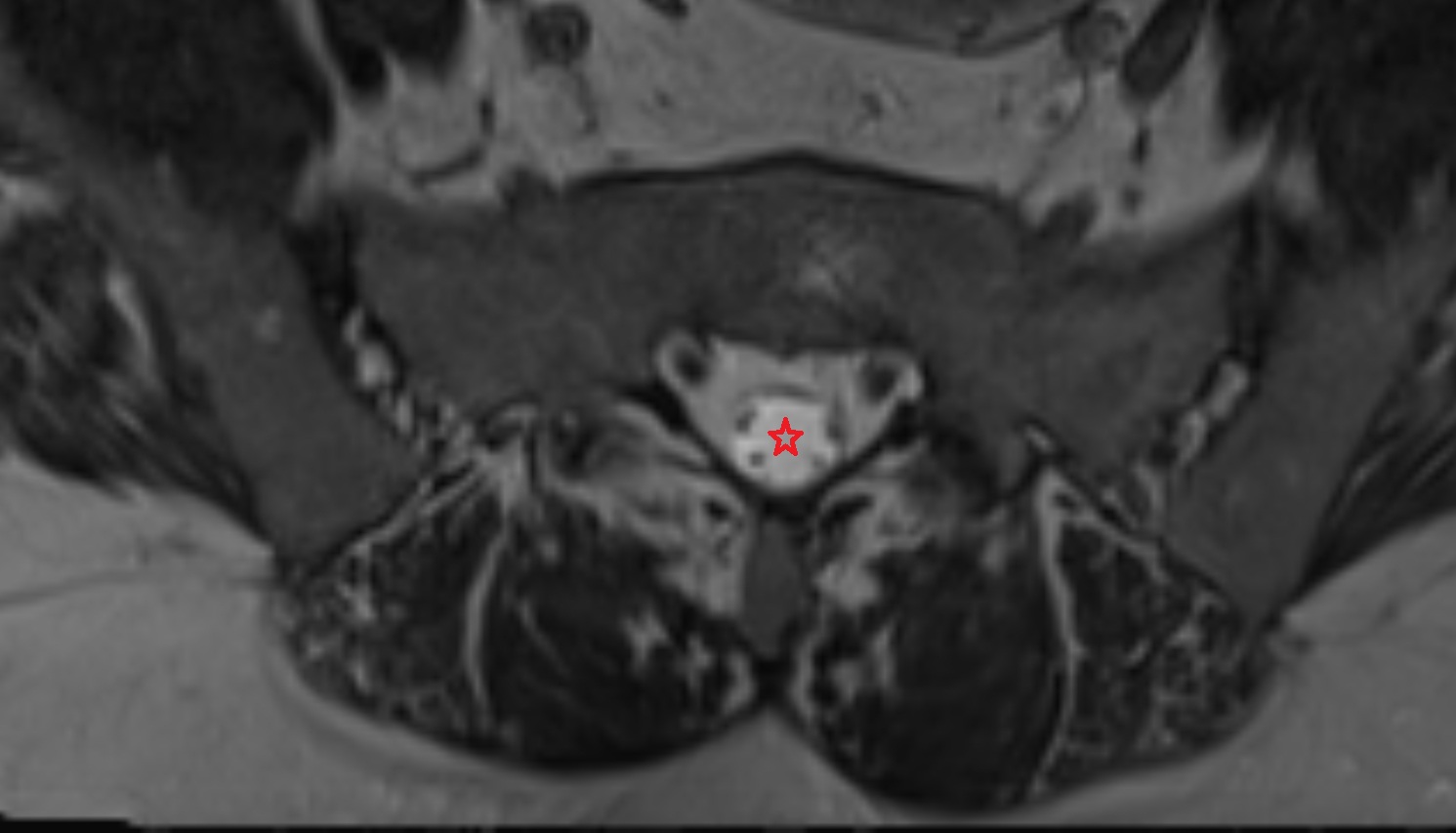 sacral canal  MRI axial  anatomy  image -img-00000-00000