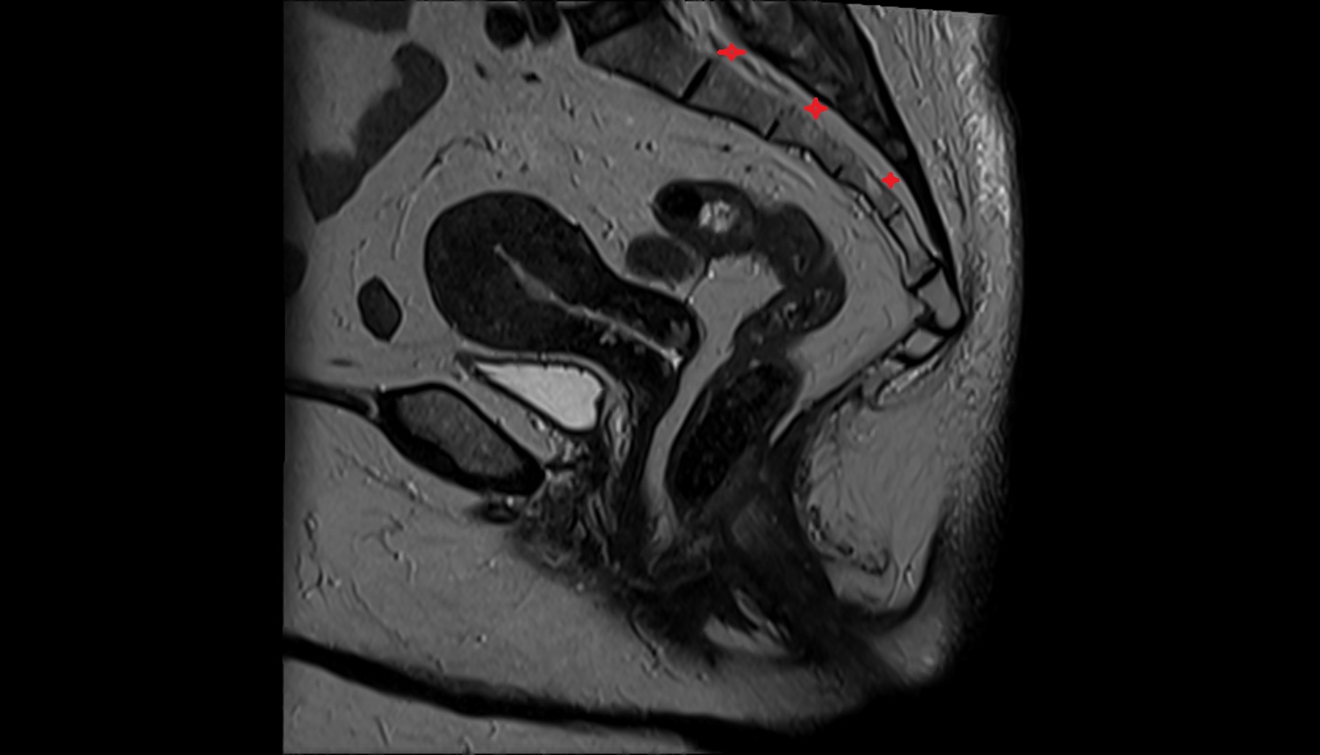 sacral canal  MRI sag anatomy  image -img-00000-00000