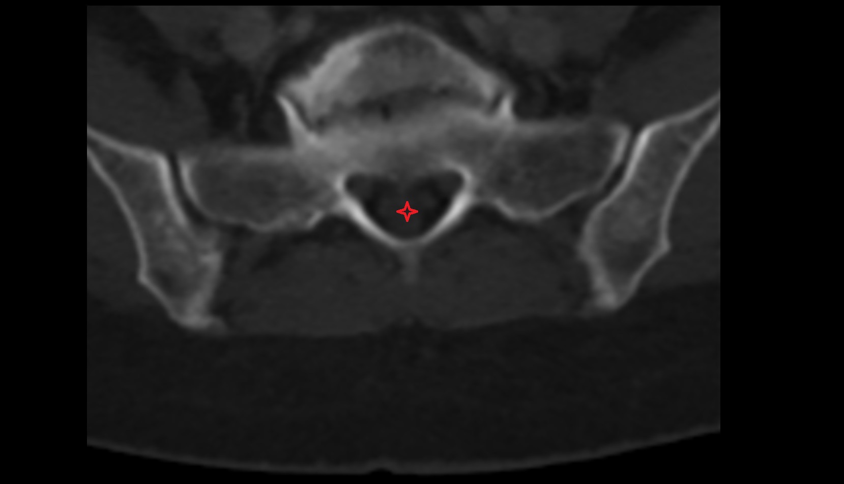 sacral canal ct axial image