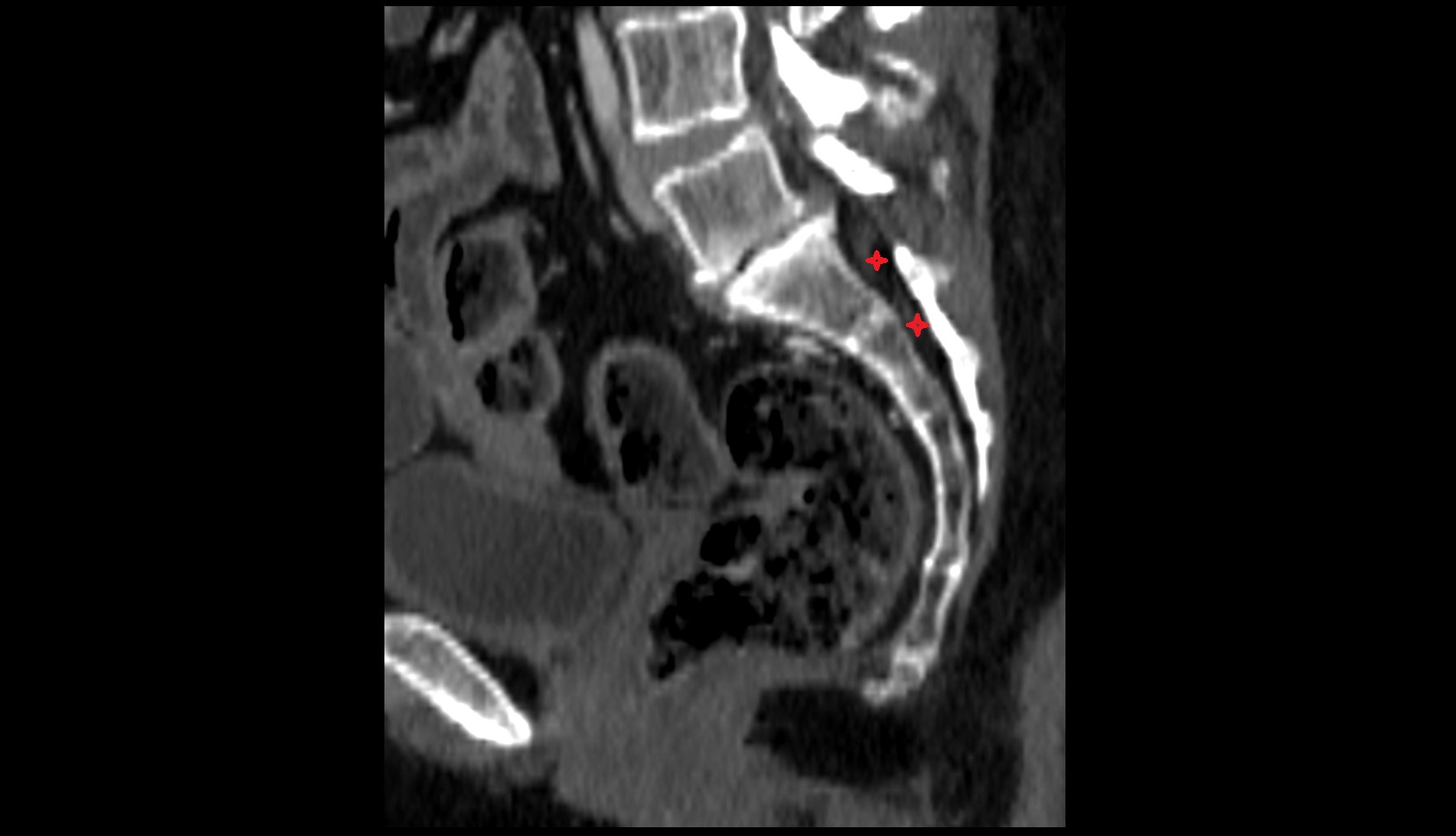 sacral canal ct sag image