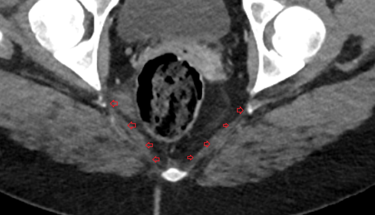 sacrotuberous ligament CT axial  anatomy  image-img-00000-00000_00001