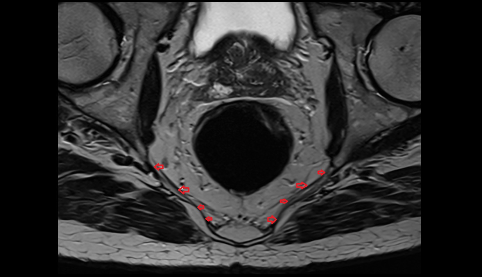 sacrotuberous ligament MRI axial image
