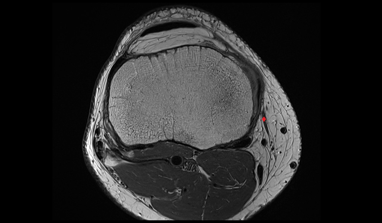 sartorius tendon anatomy image