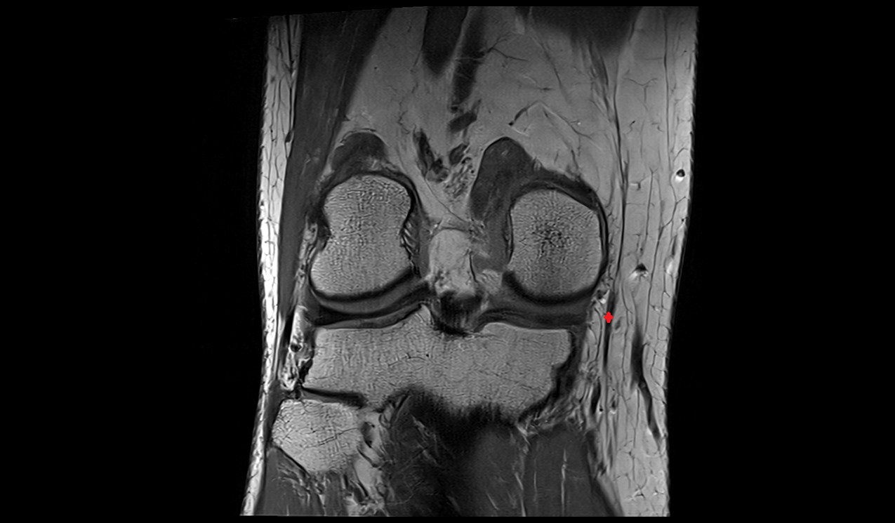 sartorius tendon anatomy image 3t mri