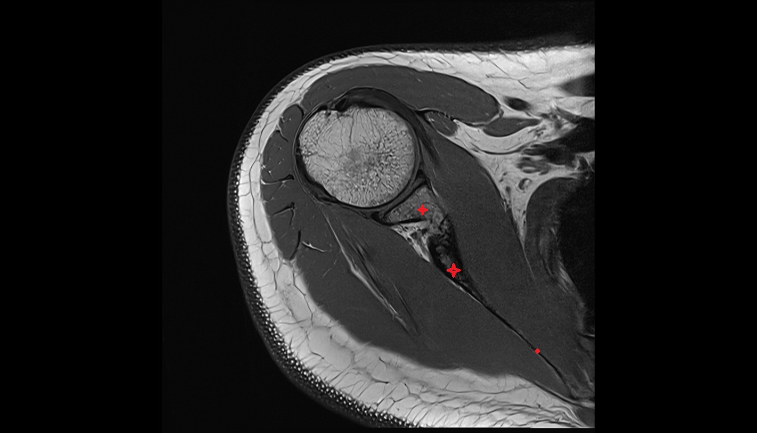 scapula MRI axial  image -img-00000-00000