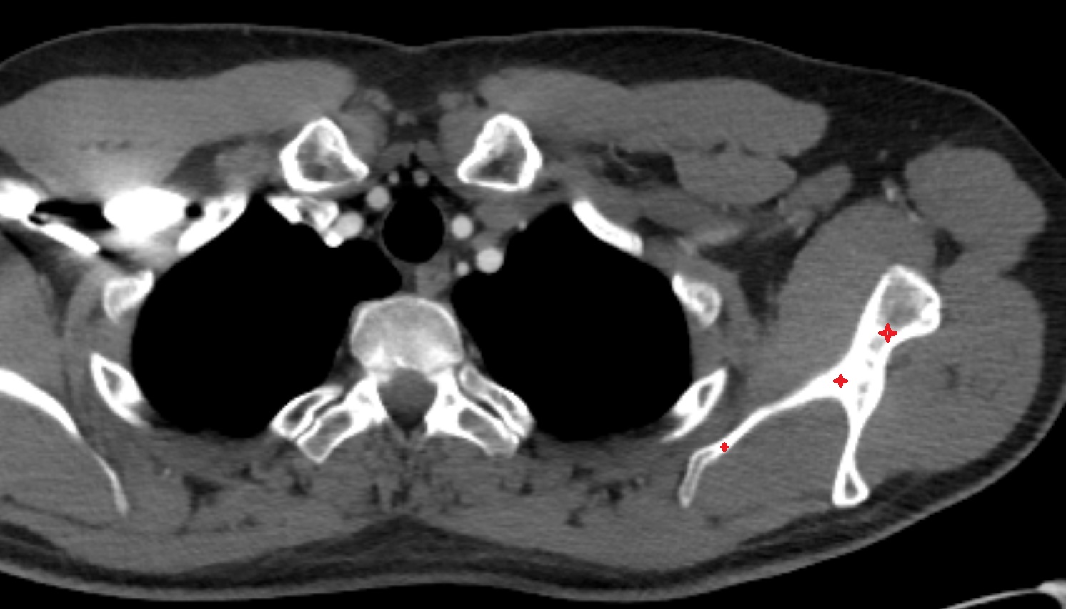 scapula ct axial  image -img-00000-00000