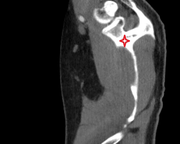 scapular body CT axial  image -img-00000-00000