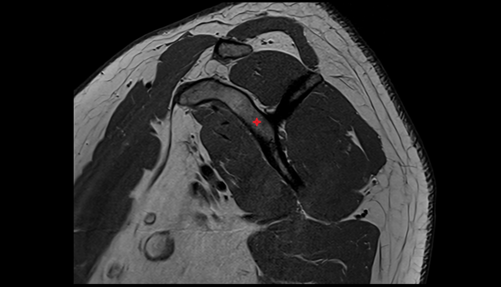 scapular body MRI SAG IMAGE