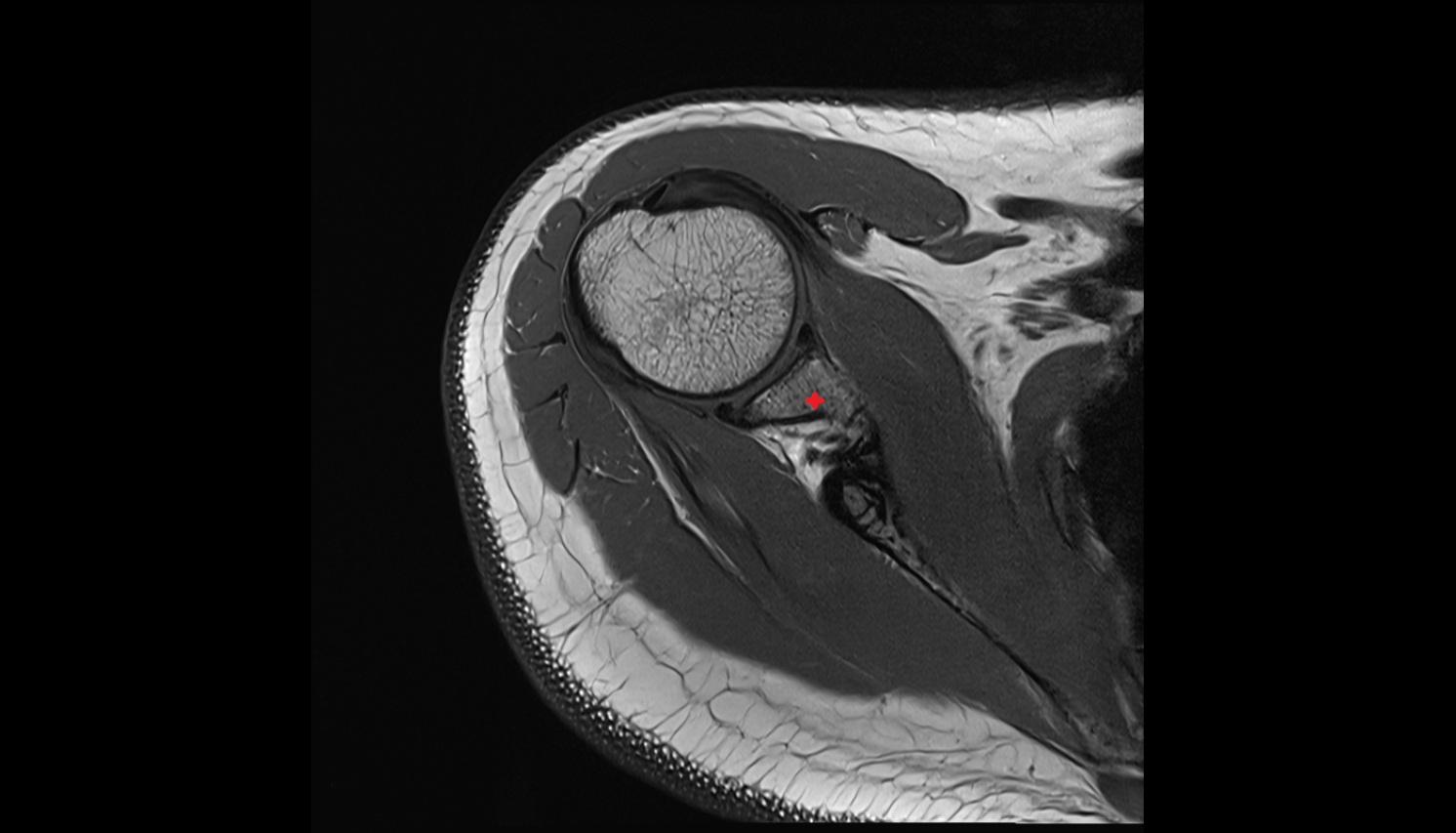 scapular body MRI axial  image -img-00000-00000