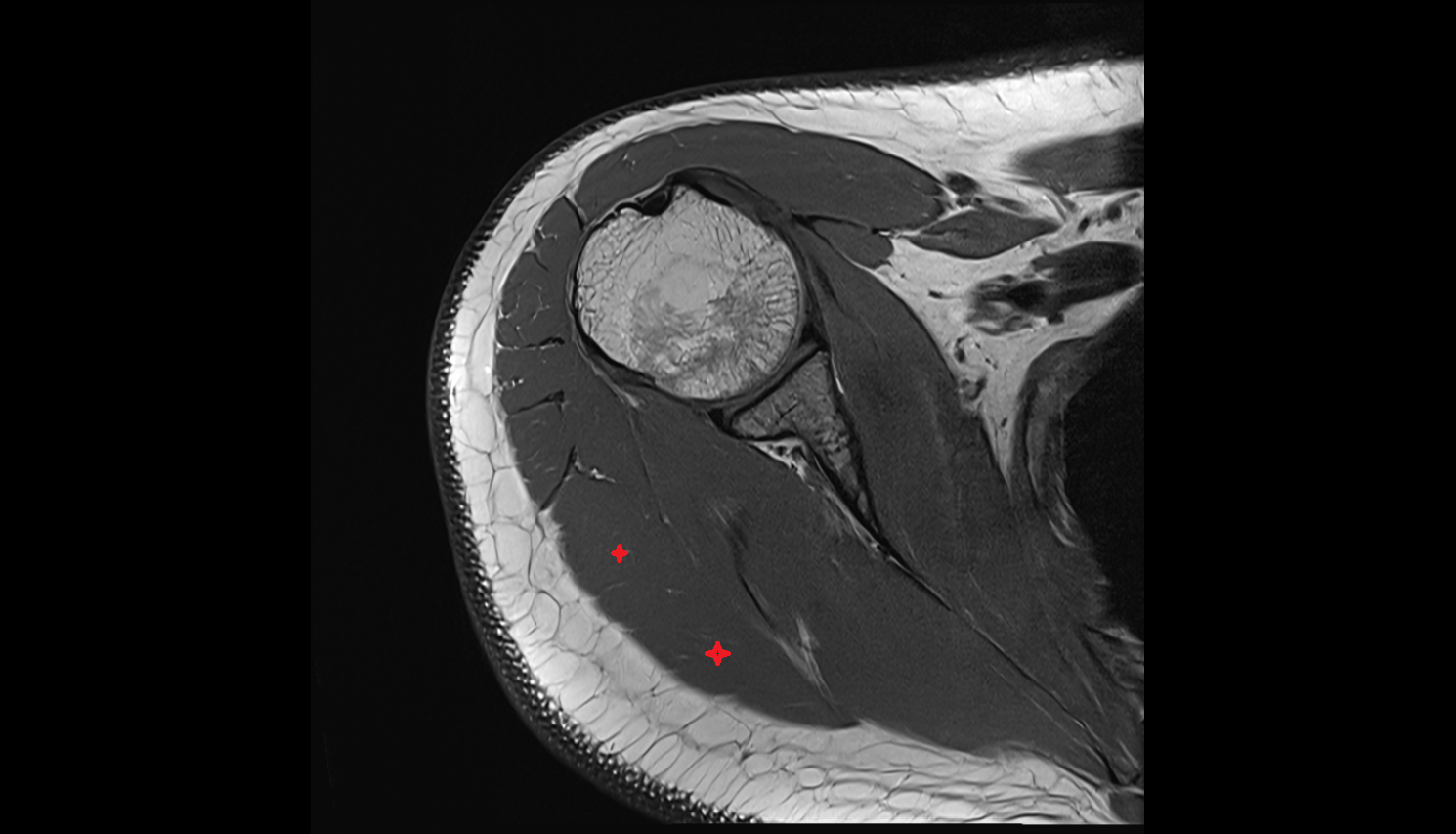 scapular spinal part of deltoid muscle AXIAL cross sectional anatomy 3T MRI AI enhanced radiology image-img-00000-00000