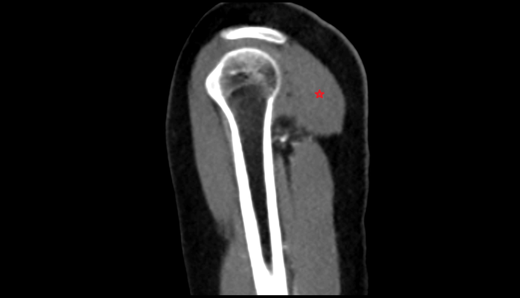 scapular spinal part of deltoid muscle CT SAG IMAGE