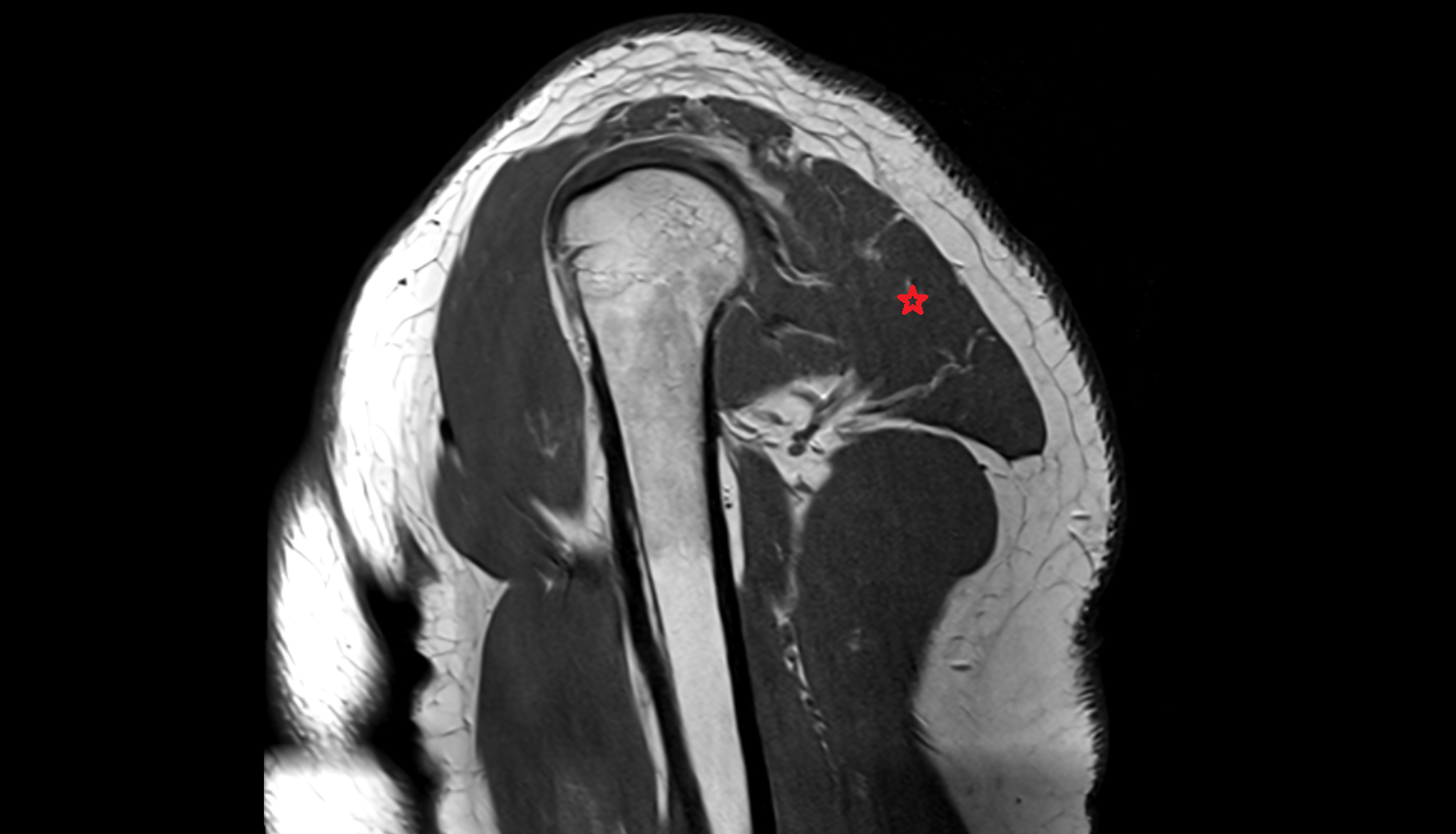 scapular spinal part of deltoid muscle sagittal cross sectional anatomy 3T MRI AI enhanced radiology image-img-00000-00000