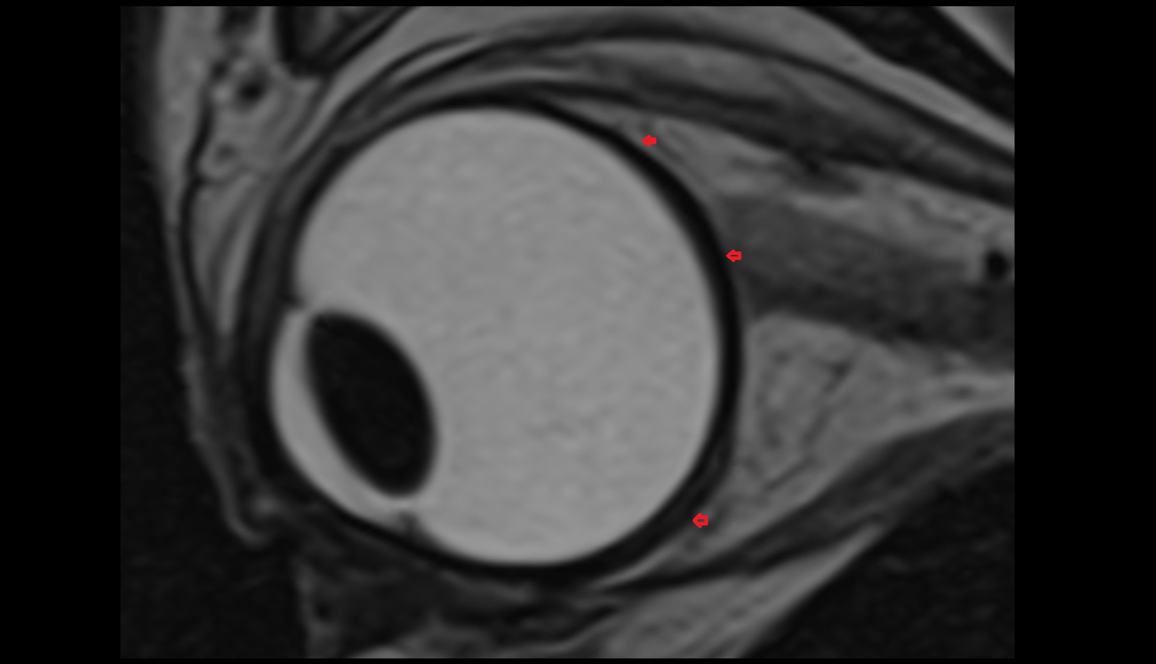 sclera mri t2 sagittal image