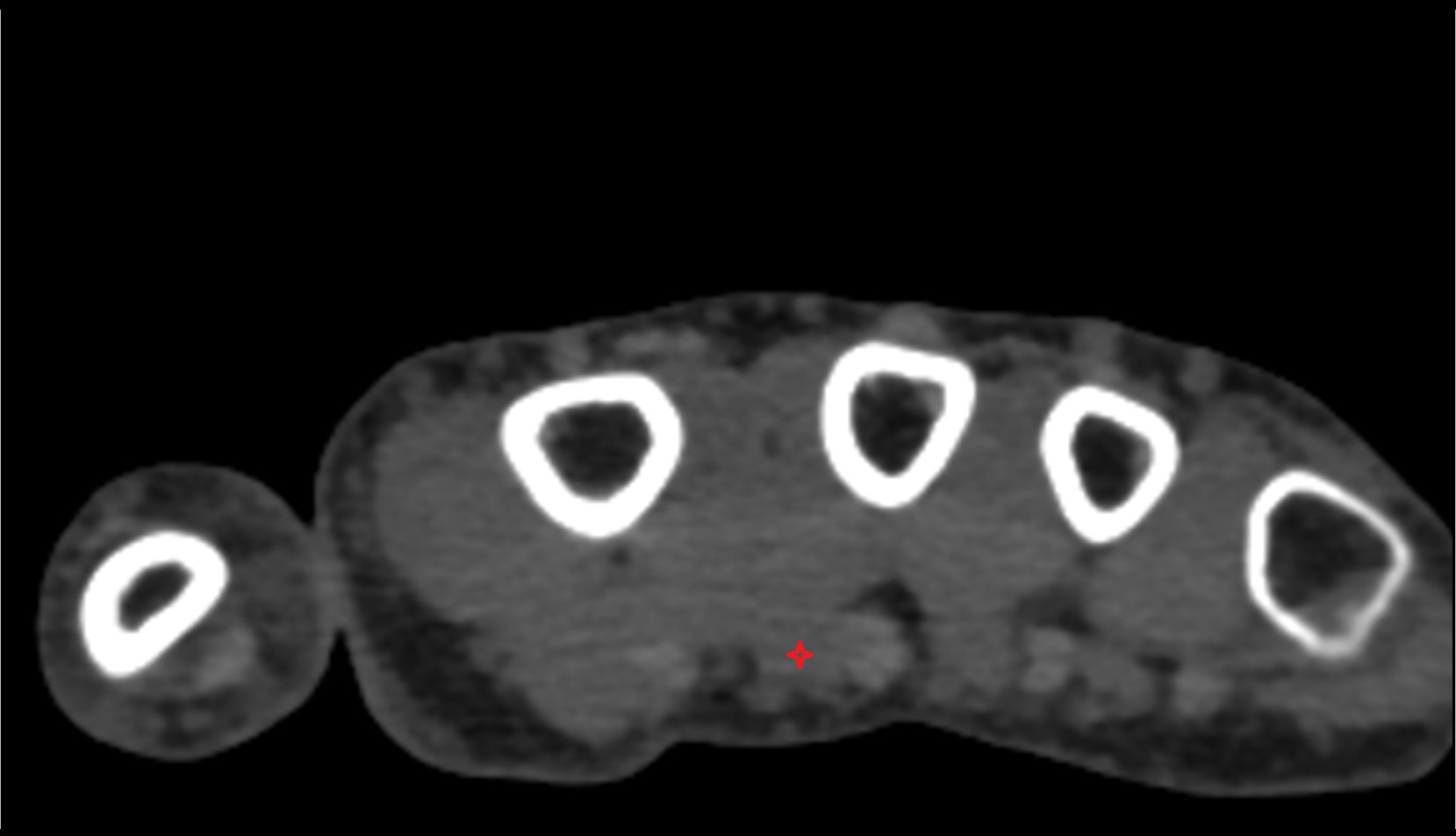 second lumbrical muscle of hand ct axial image