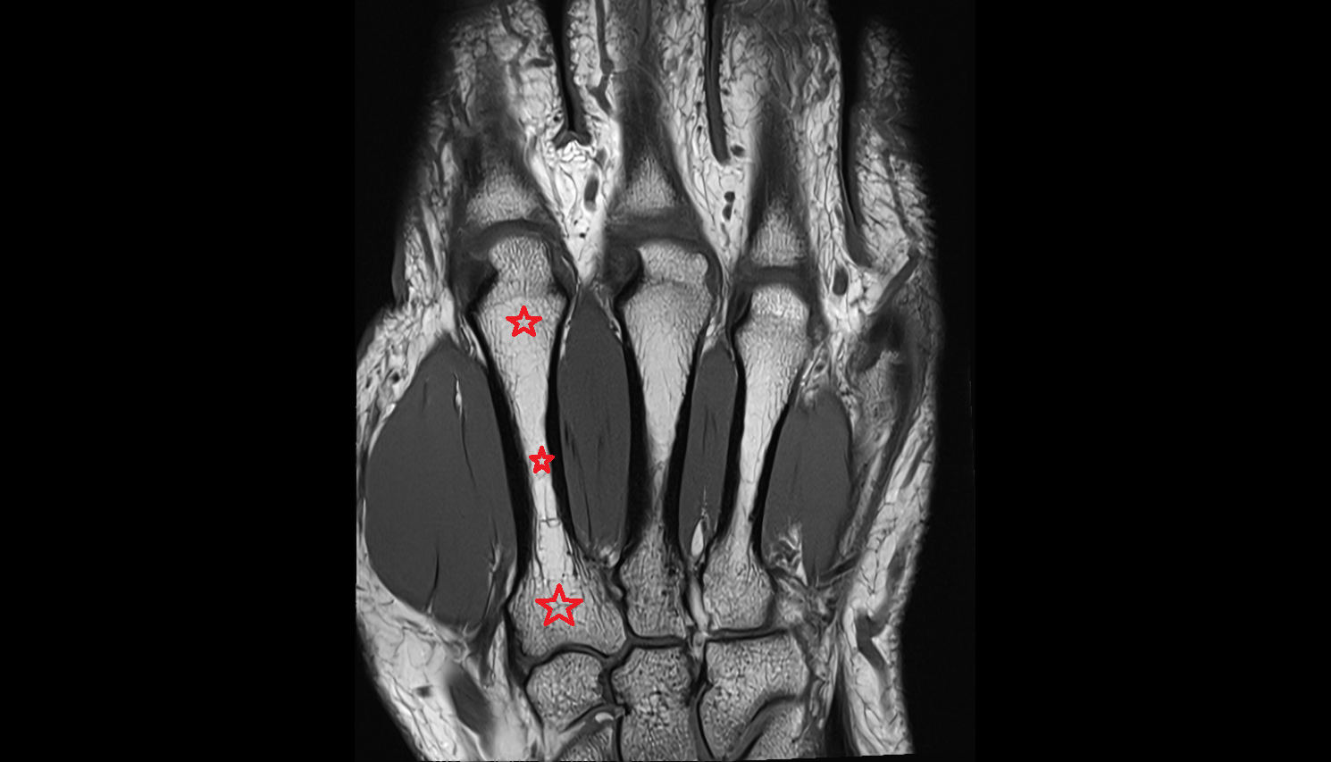 second metacarpal (Metacarpal II)  bone coronal cross sectional anatomy 3T MRI AI enhanced radiology image-img-00000-00000