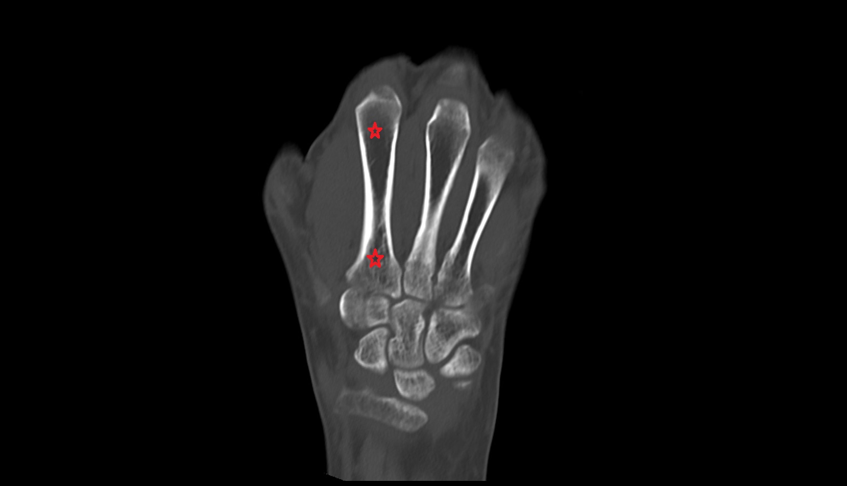 second metacarpal (Metacarpal II)  bone coronal  ct image