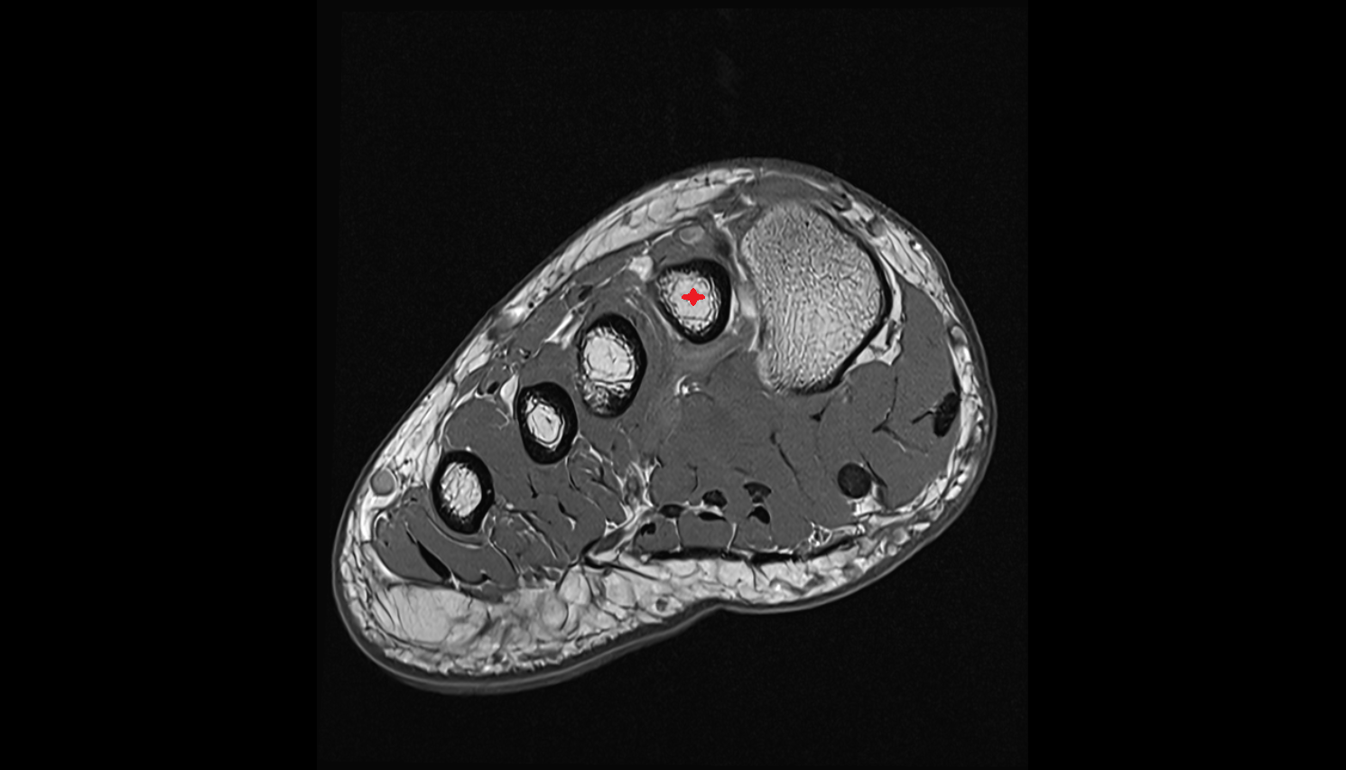 second metatarsal bone axial cross sectional anatomy 3T MRI AI enhanced radiology image-img-00000-00000