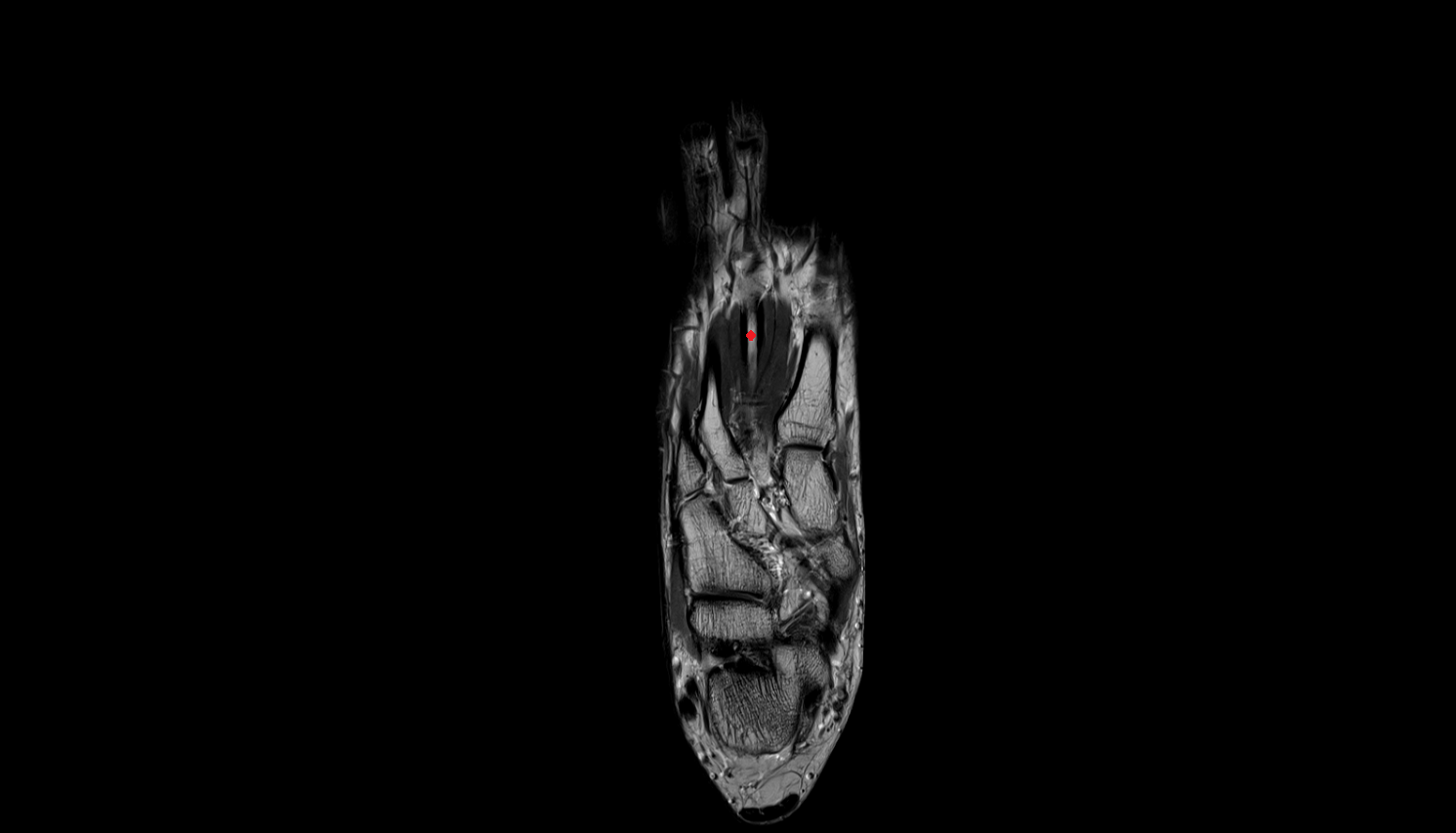 second  metatarsal bone coronal cross sectional anatomy 3T MRI AI enhanced radiology image-img-00000-00000