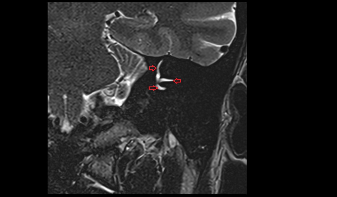semicircular canals MRI 3T coronal  image