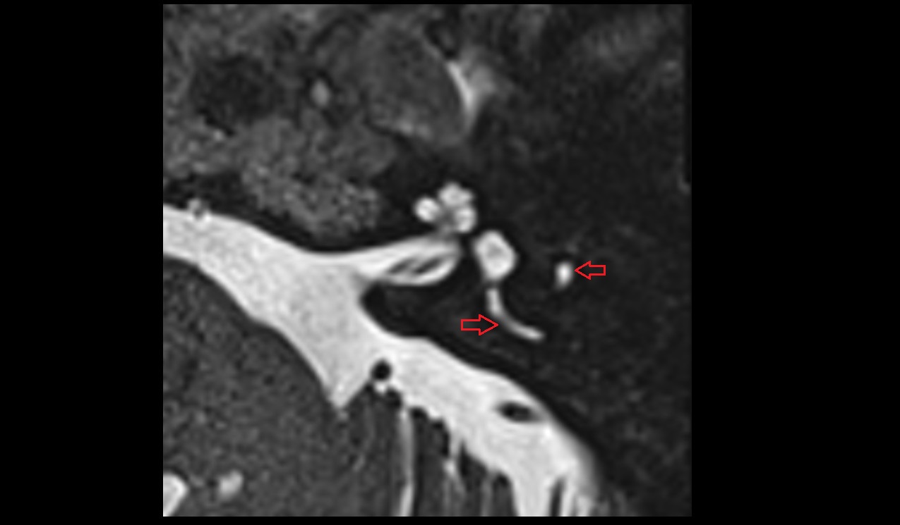 semicircular canals MRI 3T image