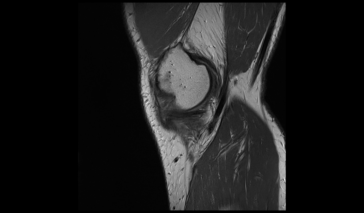 semimembranosus Tendon anatomy image