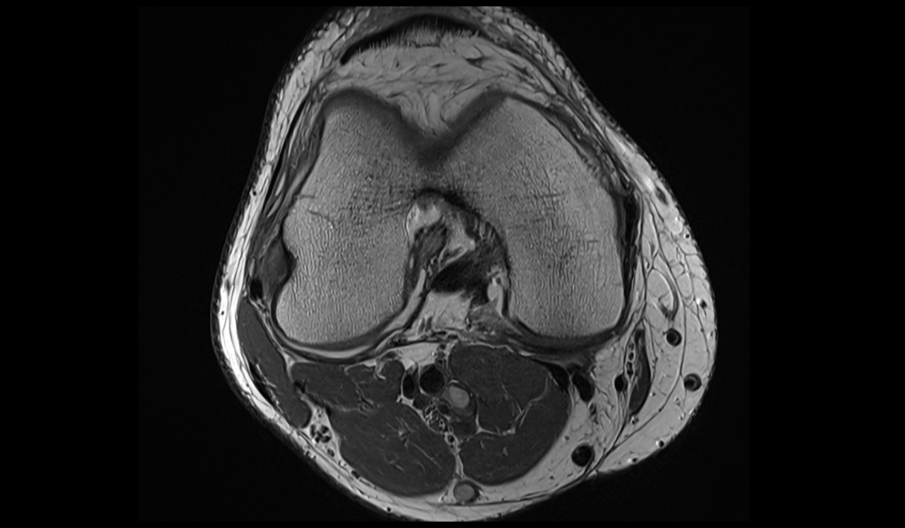 semimembranosus Tendon anatomy image 3t mri