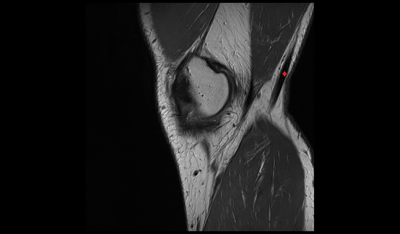 semitendinosus Tendon anatomy image mri 3t
