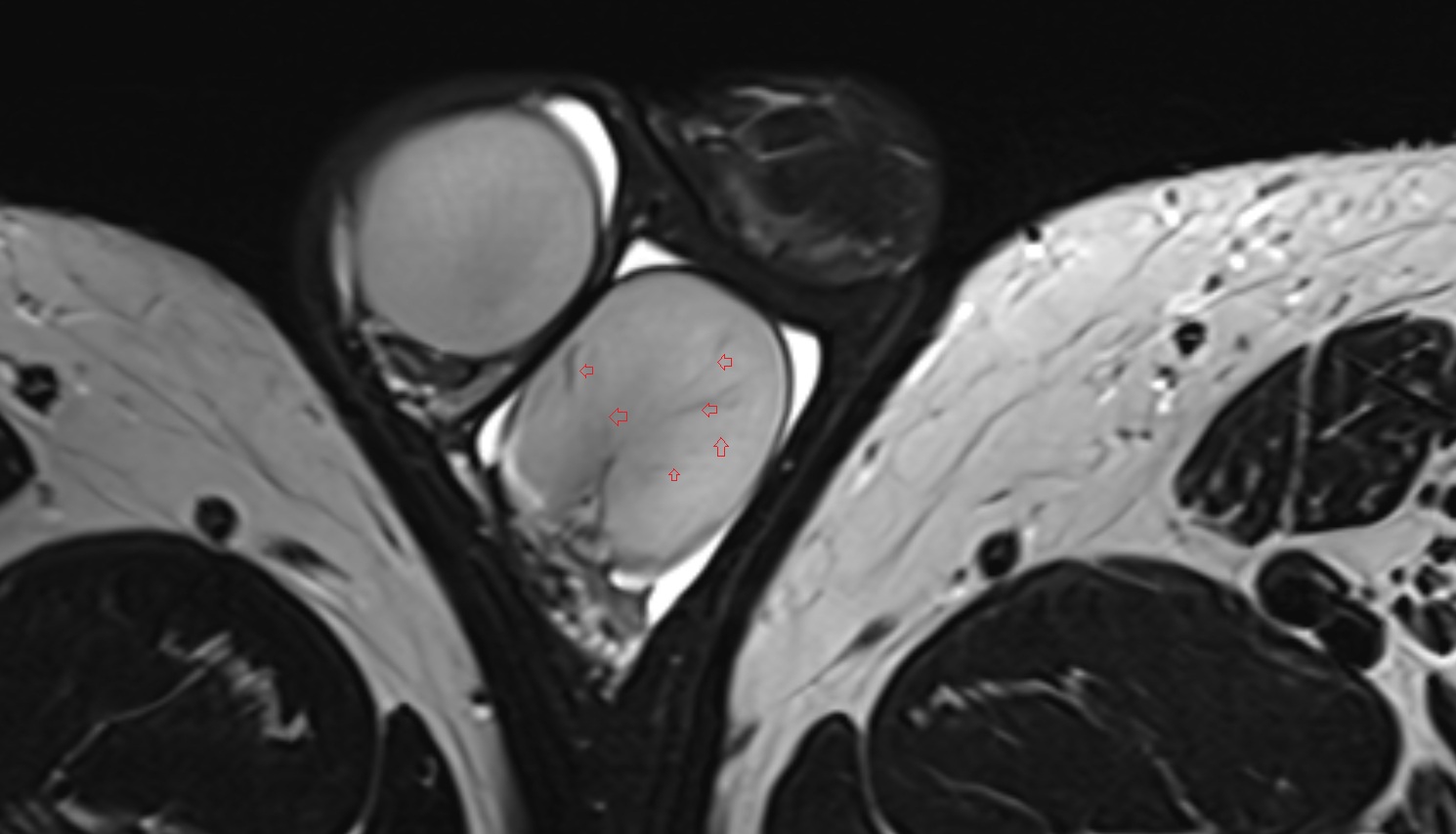 septum of the testis mri axial  anatomy  image-img-00000-00000