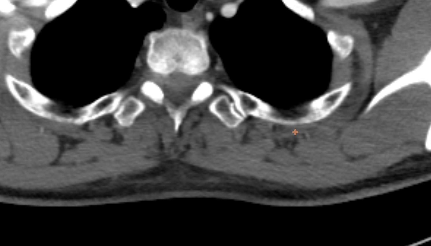 serratus posterior superior muscle  anatomy CT  axial  image -img-00000-00000_00002