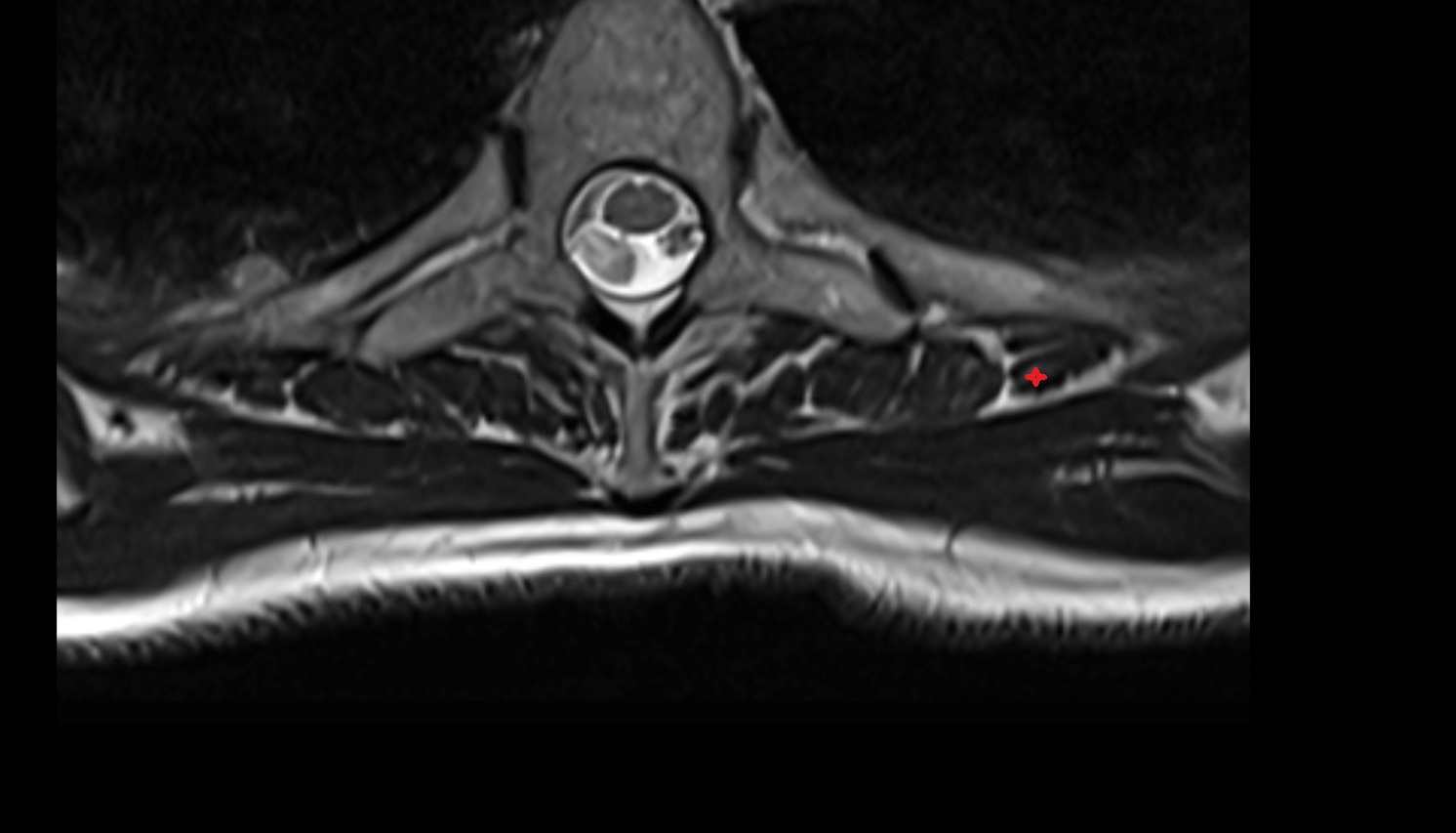 serratus posterior superior muscle  anatomy MRI  axial  image -img-00000-00000
