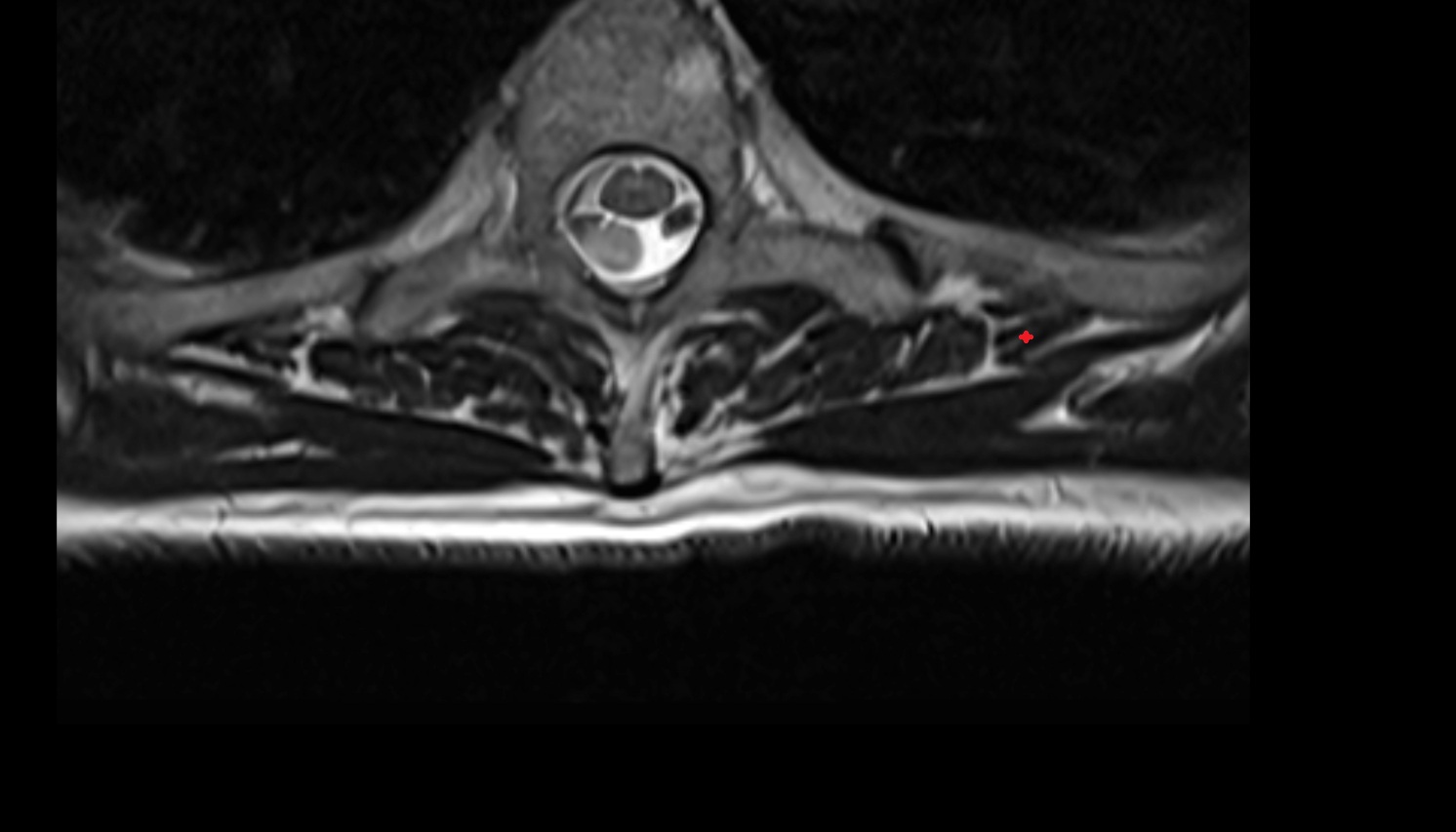 serratus posterior superior muscle  anatomy MRI  axial  image -img-00000-00000_00001