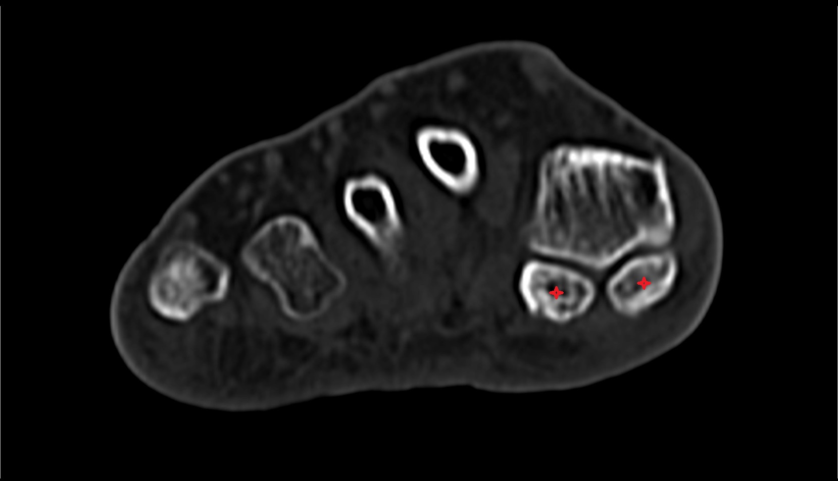 sesamoid bone great toe