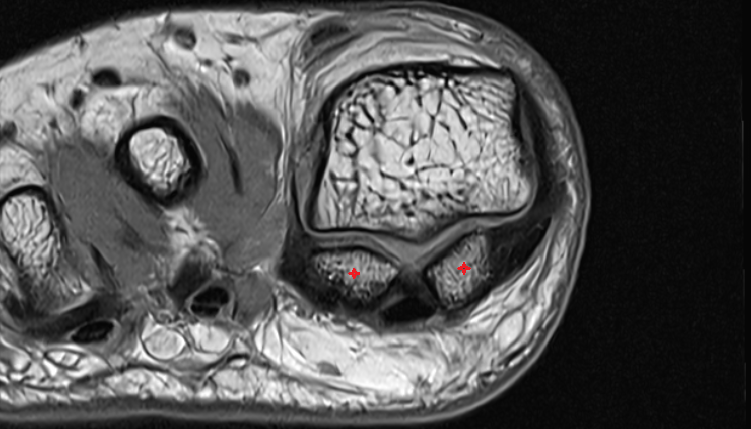 sesamoid bone great toe axial cross sectional anatomy 3T MRI AI enhanced radiology image-img-00000-00000