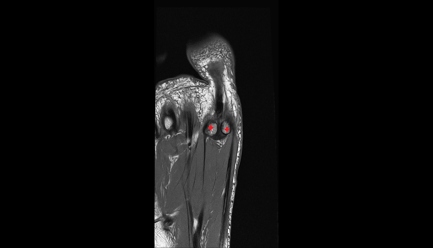 sesamoid bone great toecoronal cross sectional anatomy 3T MRI AI enhanced radiology image-img-00000-00000