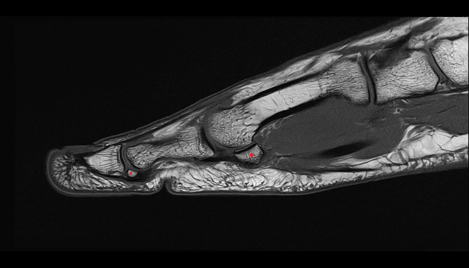 sesamoid bone great toe sag cross sectional anatomy 3T MRI AI enhanced radiology image-img-00000-00000